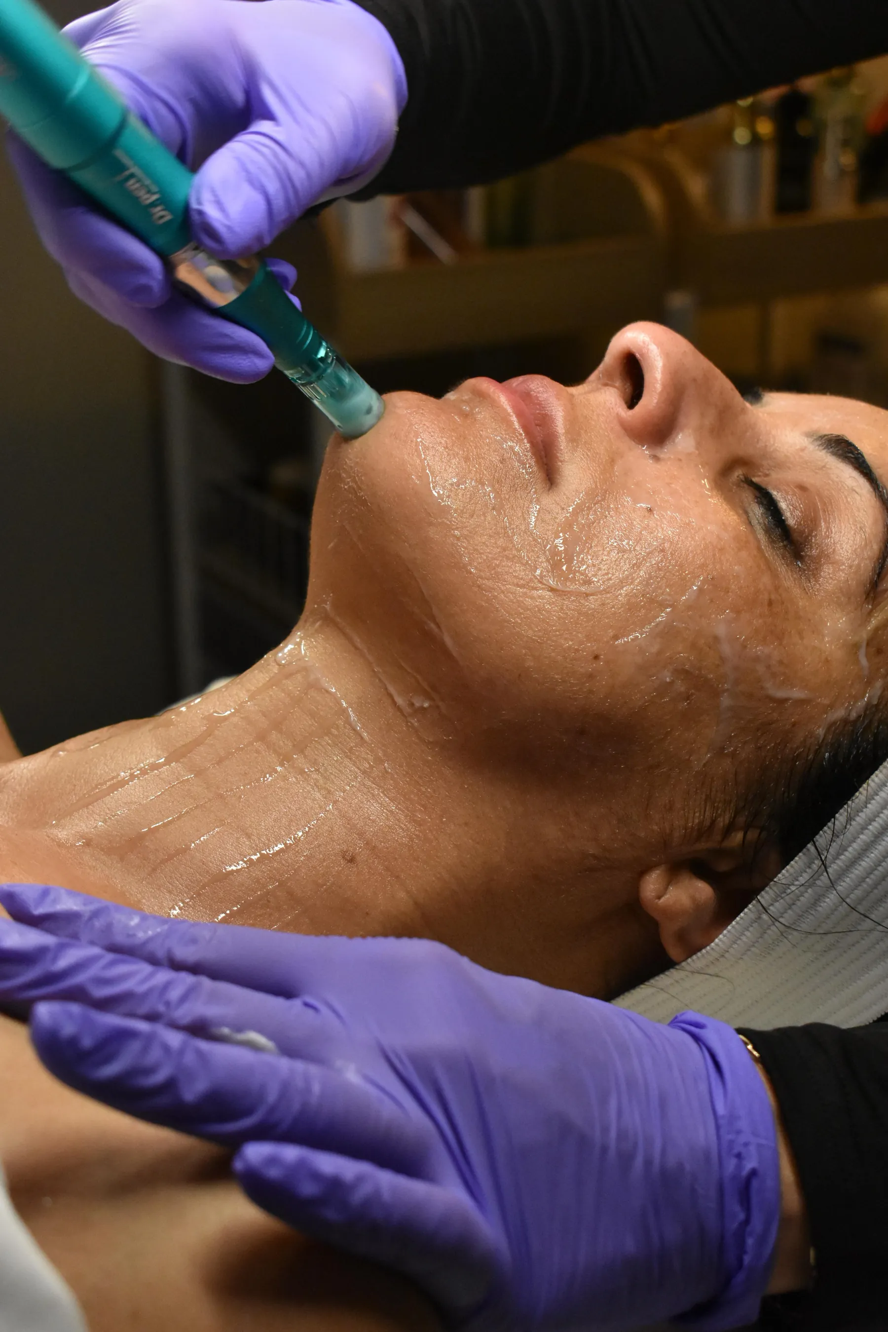 Microneedling on the face and neck