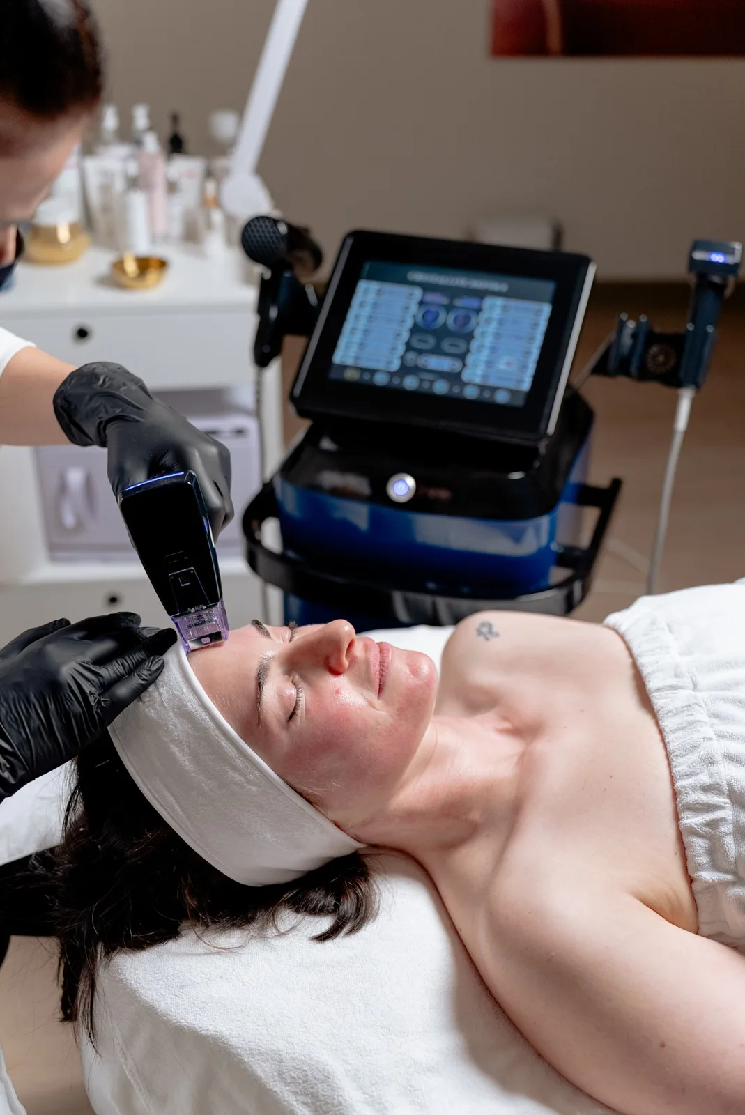 RF microneedling treatment