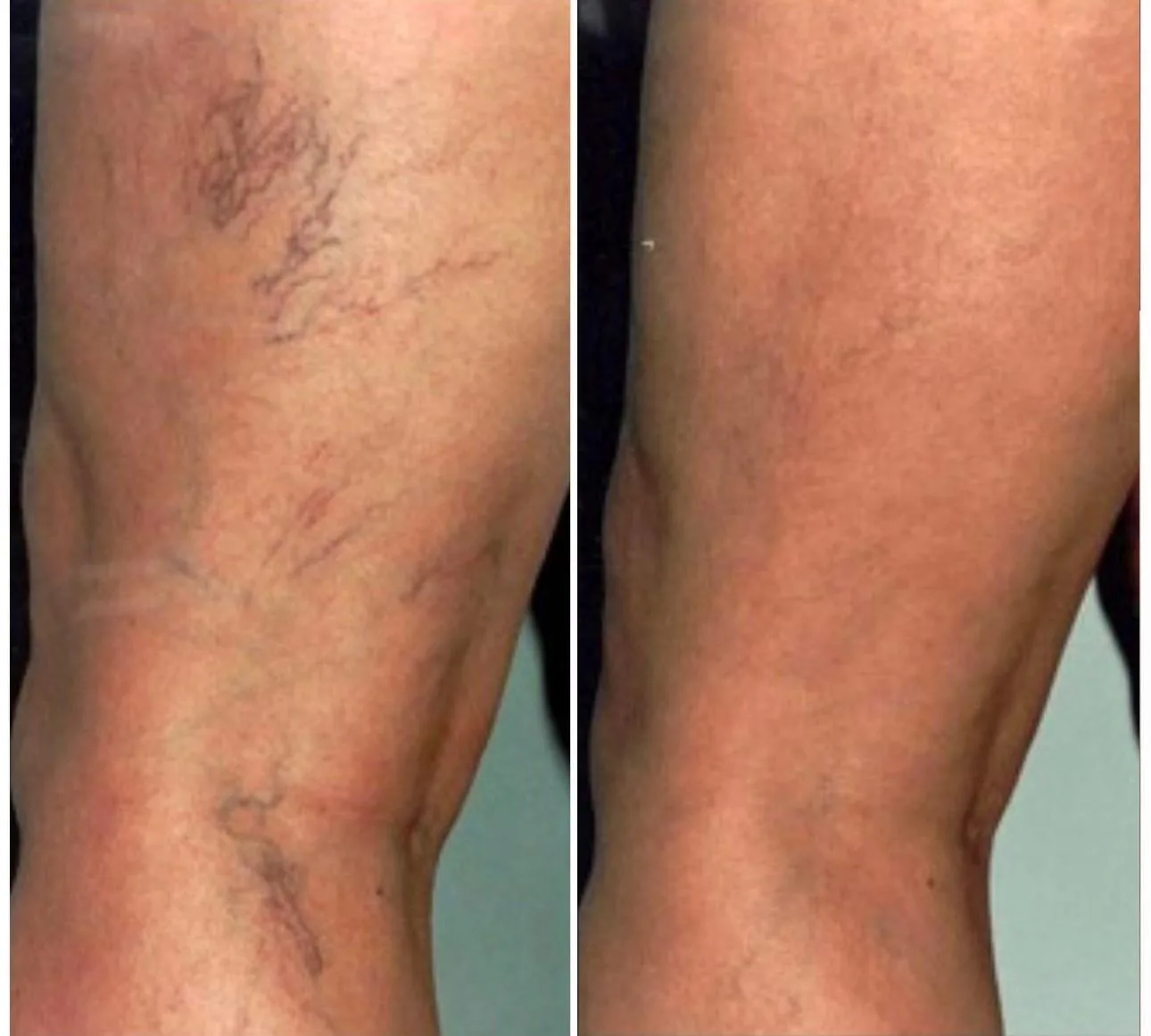 Before and after: leg skin treatment, legs, at Nuvera Med Spa