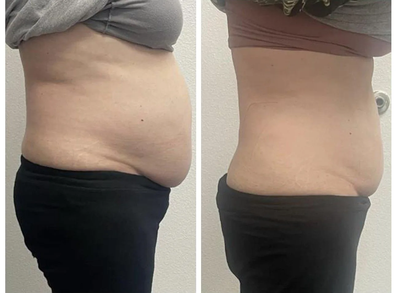 Before and after: body sculpting, abdomen, at Nuvera Med Spa