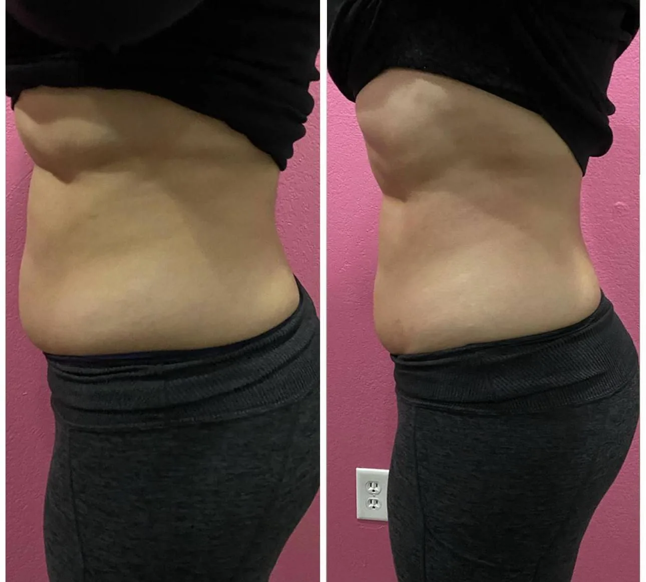 Before and after: body sculpting, abdomen, at Nuvera Med Spa