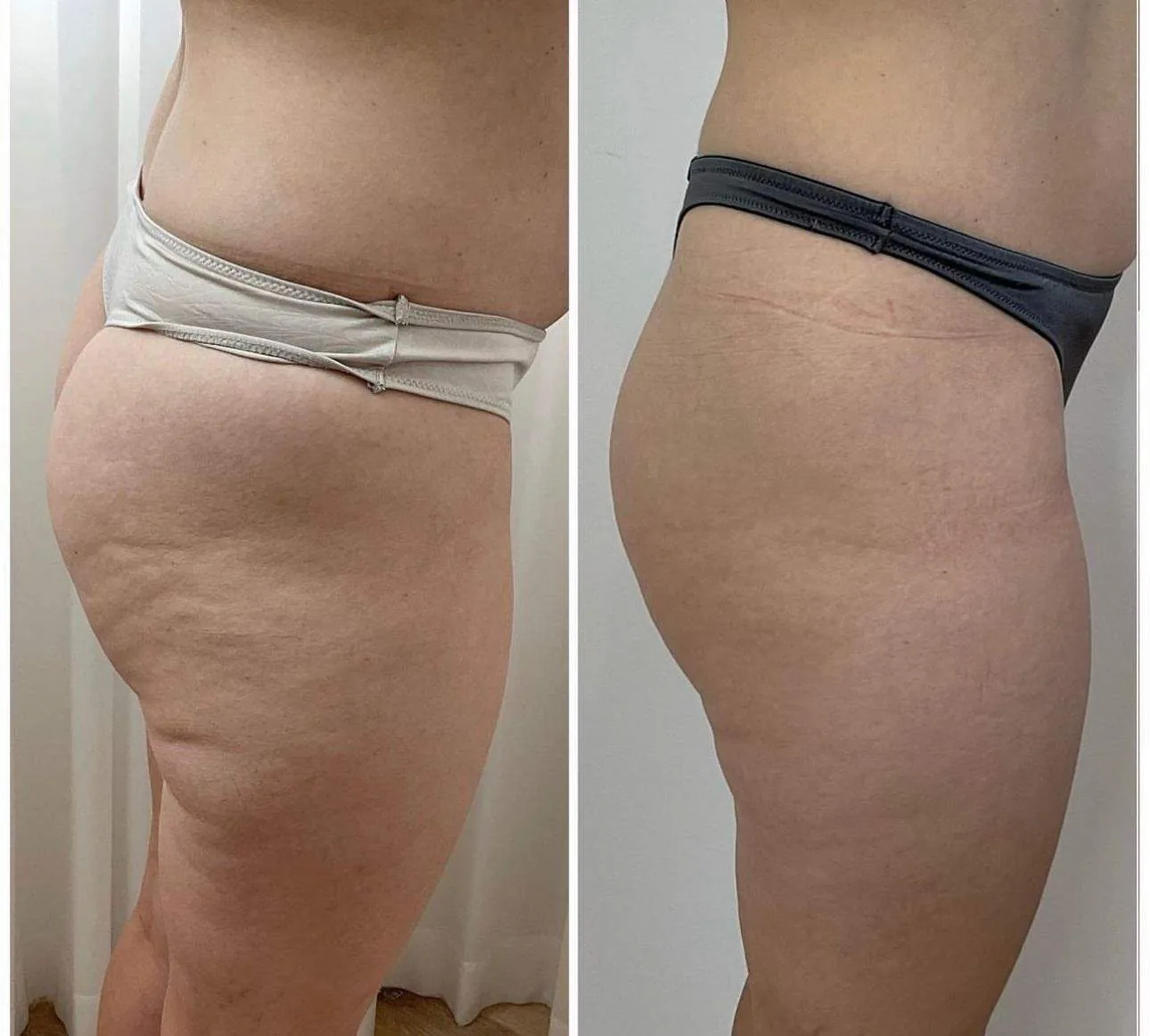 Before and after: body sculpting, buttocks and thighs, at Nuvera Med Spa