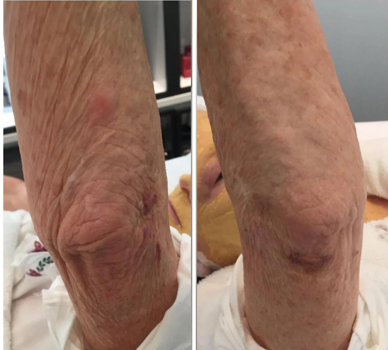Before and after: skin tightening, arm, at Nuvera Med Spa