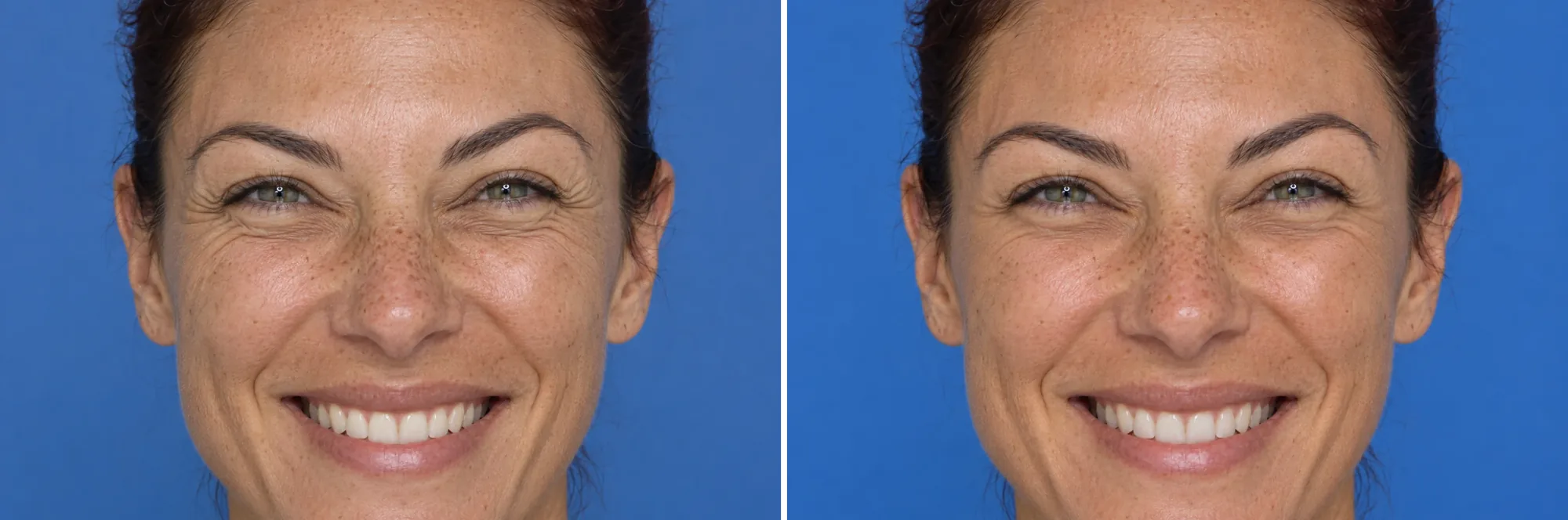 Before and after Botox: crow's feet, at Nuvera Med Spa