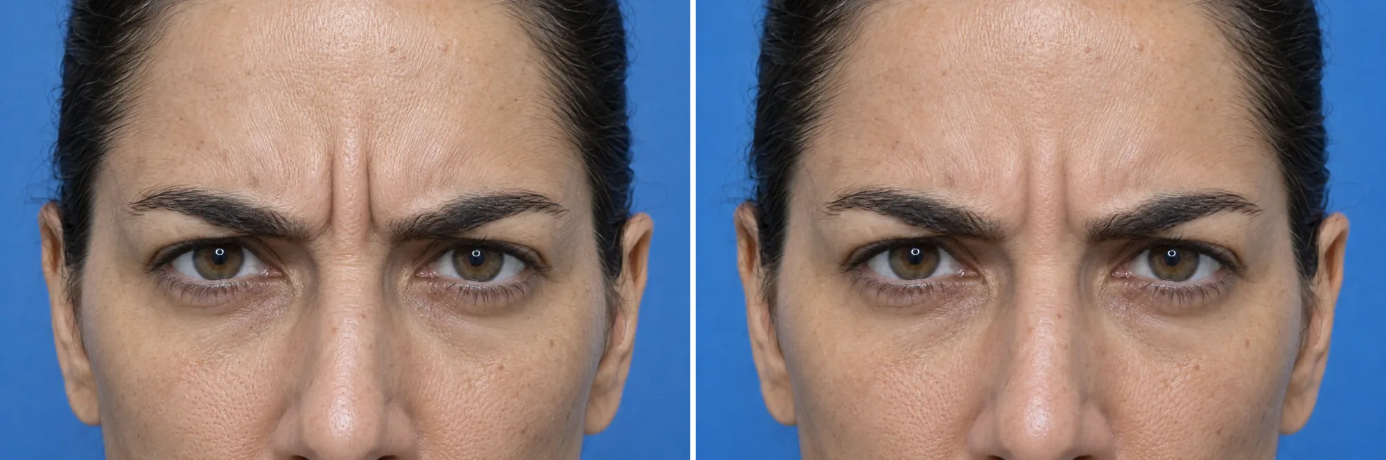 Before and after Botox: frown lines between the brows, at Nuvera Med Spa