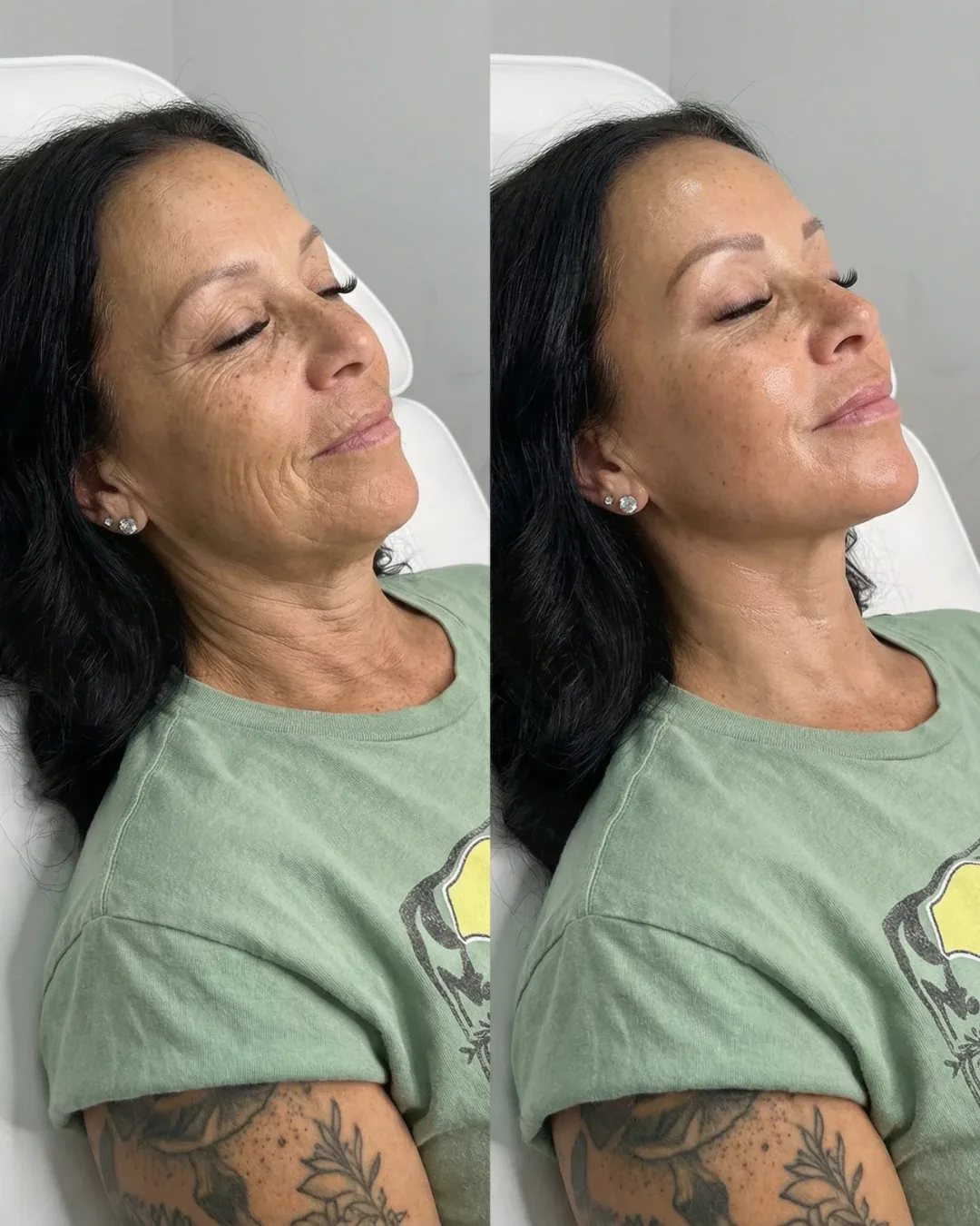 Before and after: facial treatment at Nuvera Med Spa