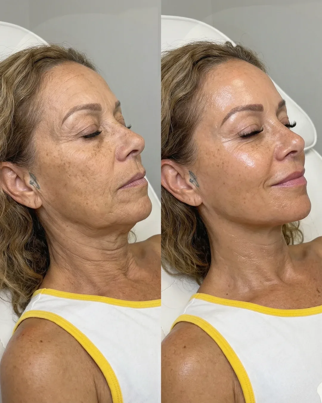 Before and after: facial treatment at Nuvera Med Spa