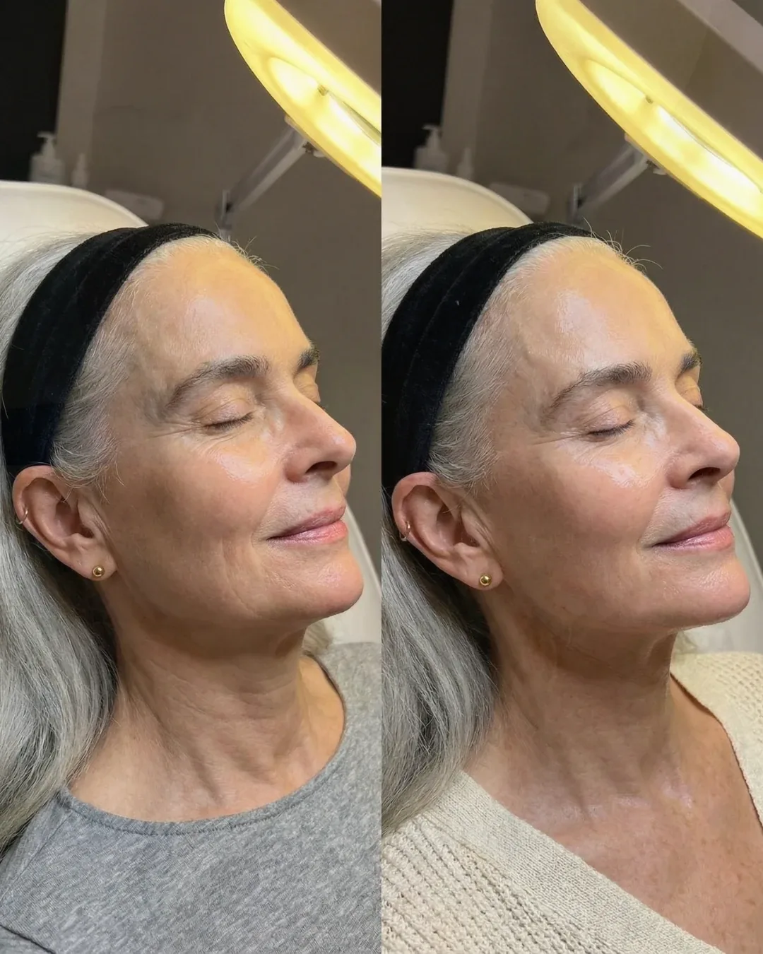 Before and after: facial treatment at Nuvera Med Spa