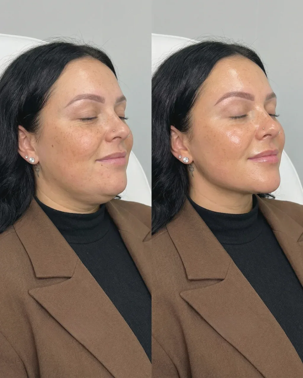 Before and after: facial treatment at Nuvera Med Spa