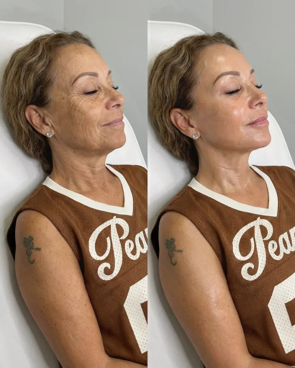 Before and after: facial treatment at Nuvera Med Spa